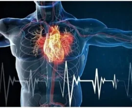 Medical illustration showing cholesterol plaque narrowing an artery and restricting blood flow